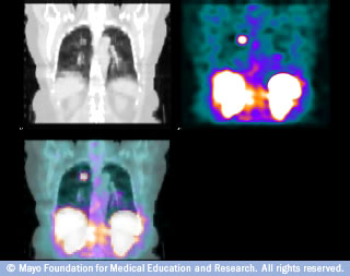 fused PET/CT scans of the chest show lung abnormalities and metabolic activity.
